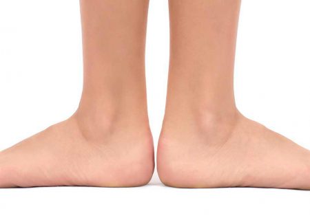 ورزشهای مخصوص برای درمان صافی کف پا