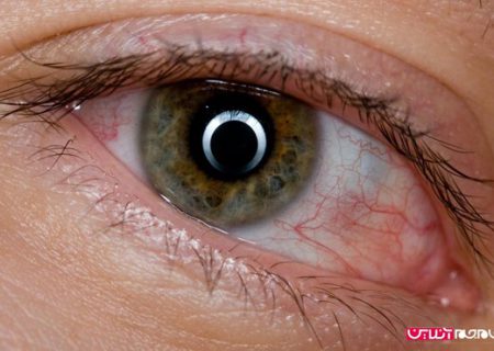 این علایم در چشم ها نشانه چیست؟
