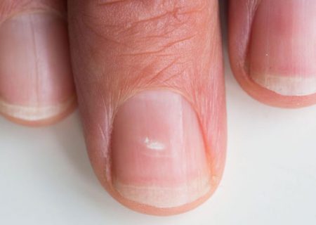 علل ایجاد لکه‌های سفید روی ناخن