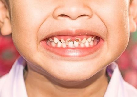 توجه به سلامت دهان و دندان‌ از کودکی