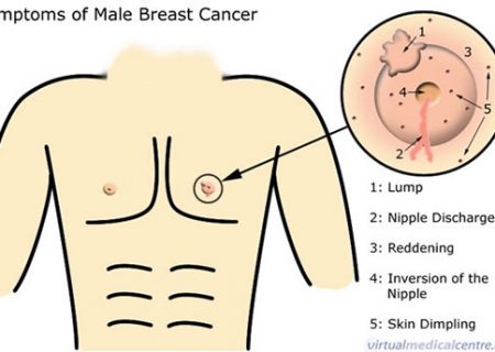 نشانه‌های سرطان سینه در آقایان
