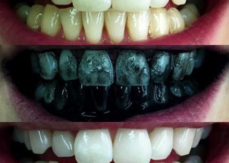 همه چیز درباره سفید کردن دندان‌ها با زغال فعال
