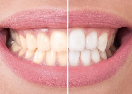 اثرات مخرب محصولات سفید کنند بر دندان
