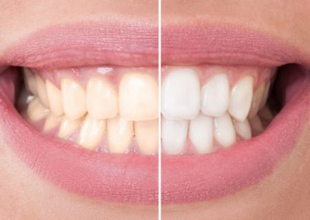 چرا دندان‌هایمان زرد است؟