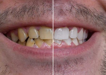چگونه دندان های زرد خود را سفید کنیم؟