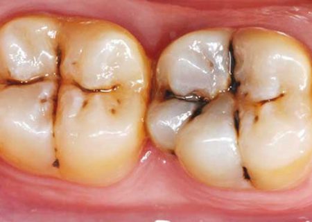 سیستم ایمنی بدن باعث پوسیدگی دندان می‌شود