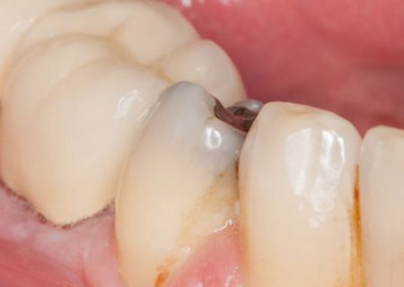 خطر‌ات جدی پوسیدگی دندان که از آن‌ها بی‌خبرید