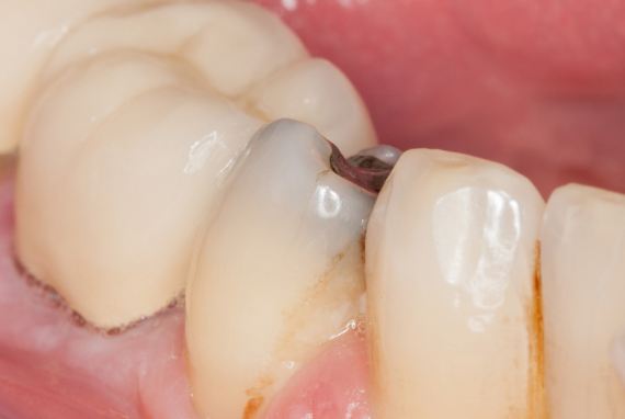خطر‌ات جدی پوسیدگی دندان که از آن‌ها بی‌خبرید
