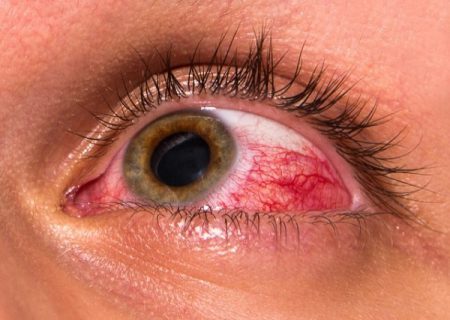 حساسیت چشمی درمان دارد؟