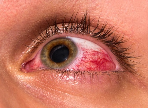 حساسیت چشمی درمان دارد؟