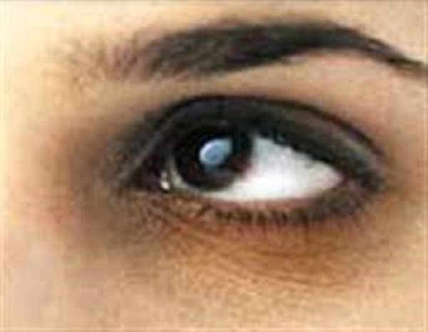 راهکاری اساسی در جهت کاهش تیرگی زیر چشم ها